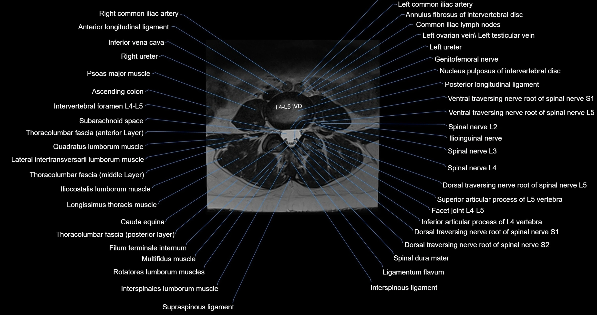 MRI lumbar spine axial cross sectional anatomy 3T radiology  image-img-00001-00034.webp